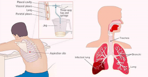 tràn dich màng phổi