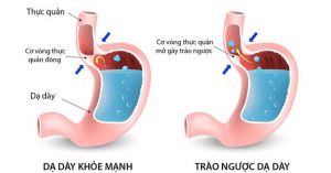 trào ngược dạ dày