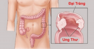 ung thư đại tràng