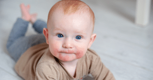 viêm da cơ địa 1