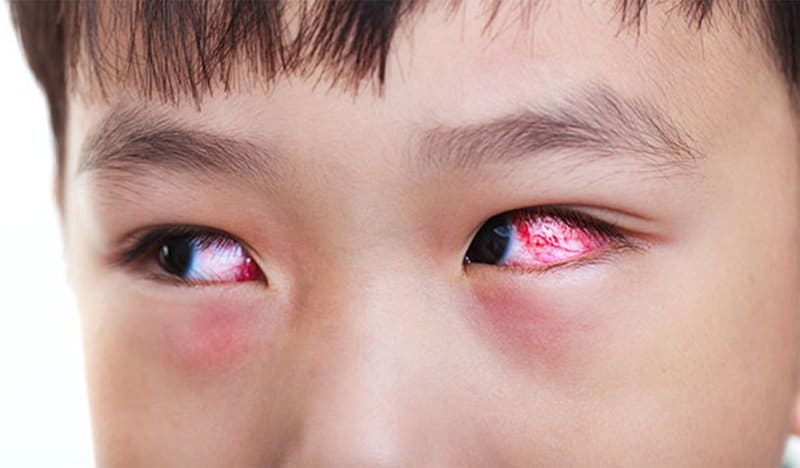 Viêm kết mạc mắt ở trẻ em 1 Viêm kết mạc mắt ở trẻ em