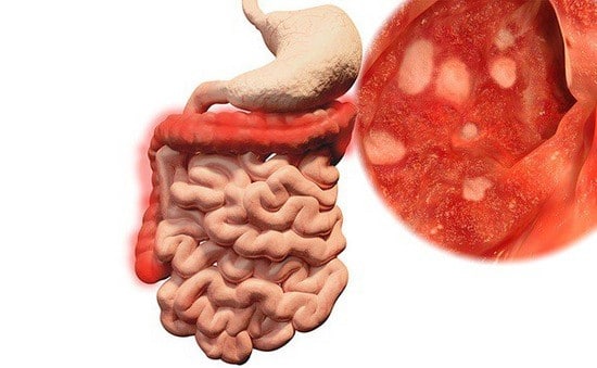 Viêm ruột là gì? 1 viêm ruột