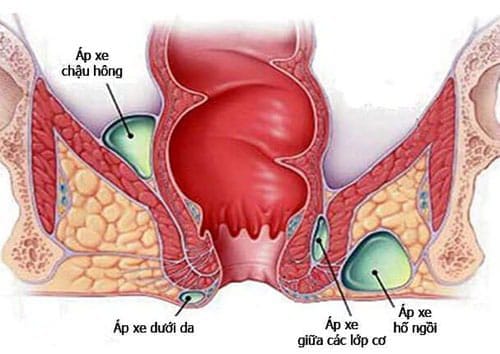 Áp xe hậu môn trực tràng: Phân loại và cách xử trí 2 áp xe hậu môn trực tràng