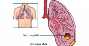p xe phổi