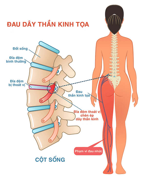 Đau dây thần kinh toạ là gì? Nguyên nhân và triệu chứng 1 đau dây thần kinh tọa