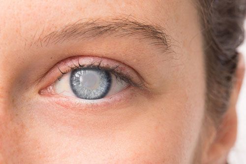 Bệnh đục thủy tinh thể ở trẻ em 1 đục thủy tinh thể ở trẻ em