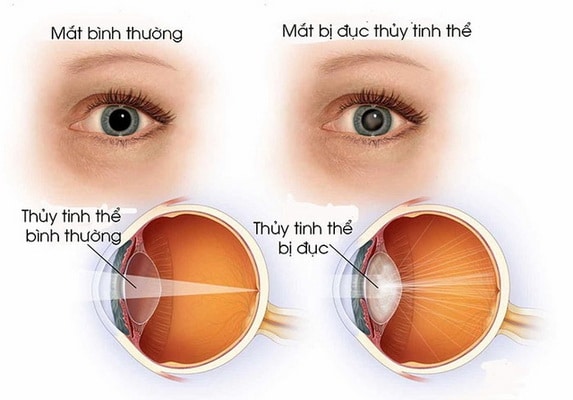 Bệnh đục thủy tinh thể ở trẻ em 2 đục thủy tinh thể ở trẻ em