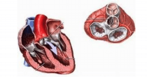 Bệnh van tim hậu thấp tim