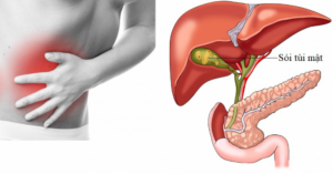 Sỏi túi mật hình thành thế nào