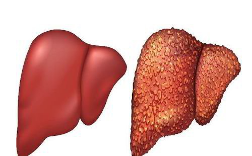 Viêm gan B là gì? 1 viêm gan B là gì