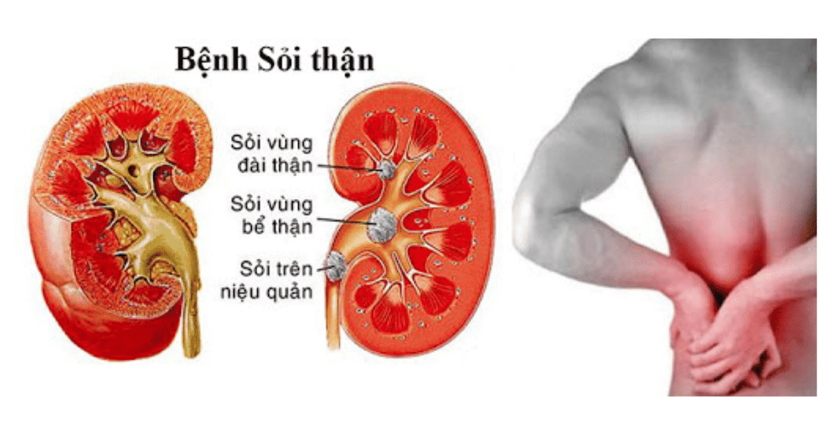 Những điều cần biết về bệnh sỏi thận - Dược Phẩm 365