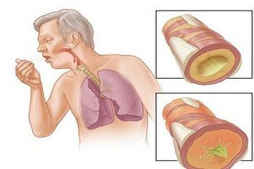Nguyên nhân bệnh bụi phổi atbet 6 bệnh bụi phổi atbet