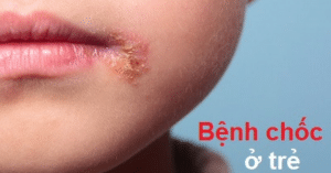 bệnh chốc lây