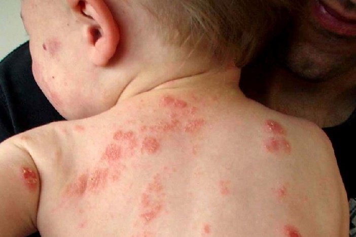 Bệnh chốc lây ngoài da ở trẻ nhỏ 2 bệnh chốc lây