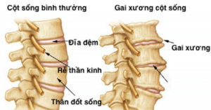 bệnh gai cột sống