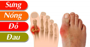 bệnh gout 1