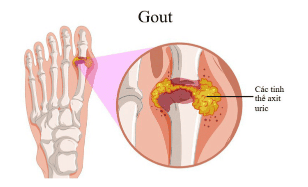 Chế độ ăn cho người bị bệnh Gout 1 bệnh gout