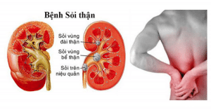 bệnh sỏi thận