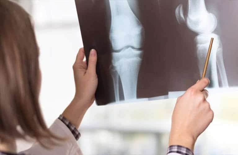 Bệnh viêm khớp là gì nguyên nhân, triệu chứng 3 bệnh viêm khớp