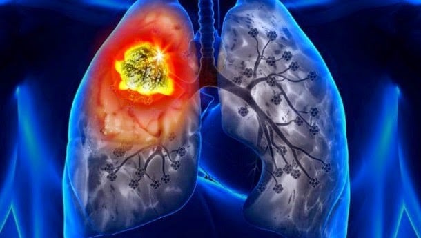 Nguyên nhân bệnh bụi phổi atbet 2 bụi phổi atbet