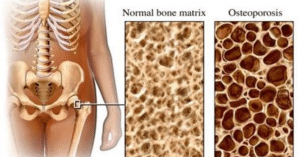 loãng xương