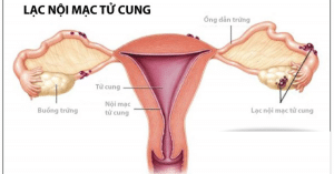 lạc nội mạc tử cung