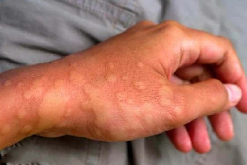 Tìm hiểu lý do gây nổi mề đay 2 mề đay