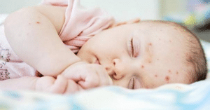 mụn cóc ở trẻ em và tẻ sơ sinh