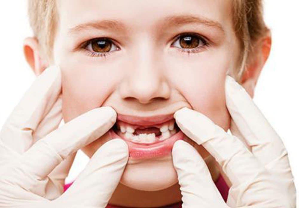 Nguyên nhân sâu răng ở trẻ em 2 nguyên nhân gây sâu răng ở trẻ em