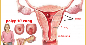 polyp cổ tử cung