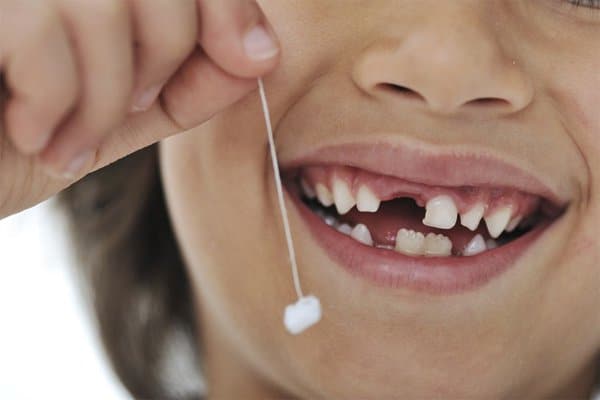 Làm thế nào khi bé bị sún răng sớm? 3 sún răng