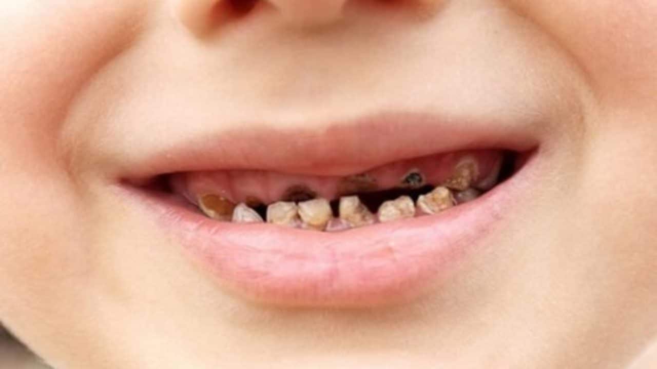 Làm thế nào khi bé bị sún răng sớm? 2 sún răng