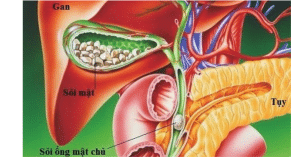 sỏi ống mật chủ