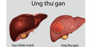 ung thư gan 1