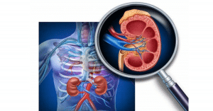 viêm cầu thận mạn