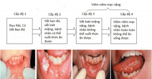 viêm loét miệng do hóa trị