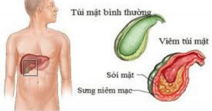 viêm túi mật