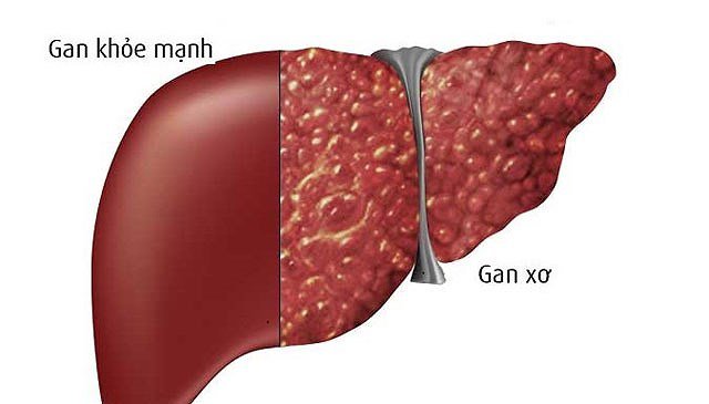 Biến chứng nguy hiểm của bệnh xơ gan 2 xơ gan