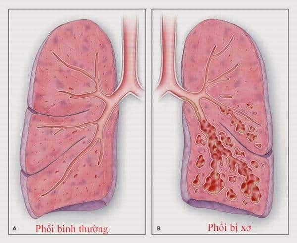 bệnh xơ phổi 