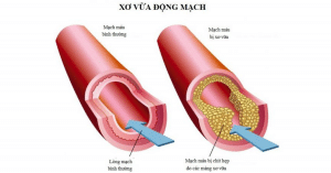 xơ vữa động mạch não