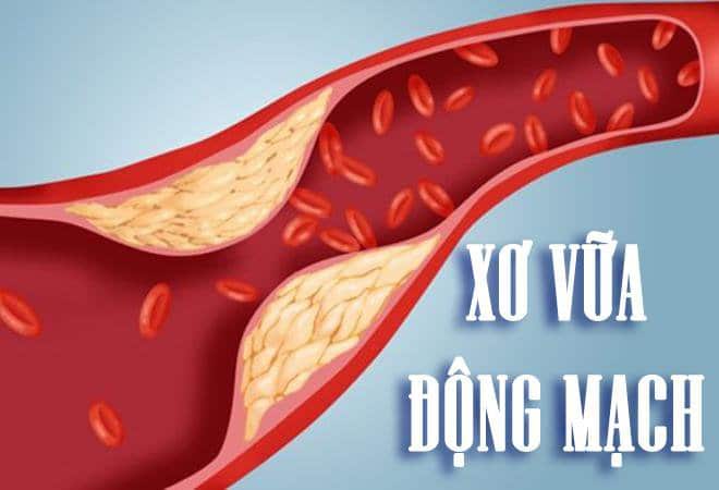 Xơ vữa động mạch não 2 xơ vữa động mạch não