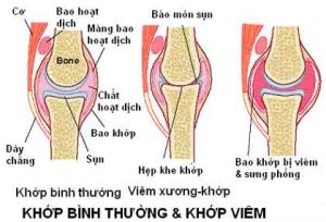 Hình ảnh khớp bình thường và khớp bị viêm