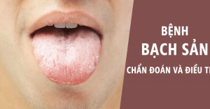 bạch sản miệng