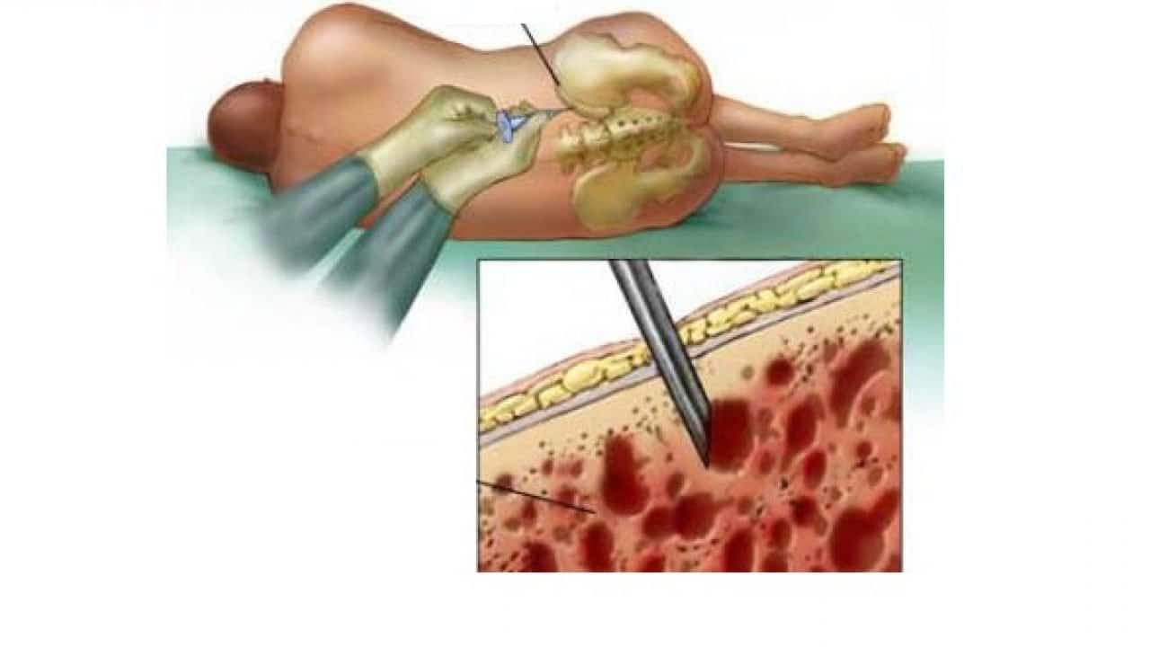 Vai trò của sinh thiết tủy xương 3 sinh thiết tủy xương
