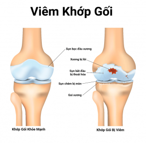 VIÊM KHỚP CĂN BỆNH NGÀY CÀNG PHỔ BIẾN Ở GIỚI TRẺ 2 tình trạng viêm khớp gối