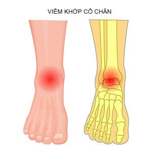 VIÊM KHỚP CĂN BỆNH NGÀY CÀNG PHỔ BIẾN Ở GIỚI TRẺ 3 viêm khớp cổ chân