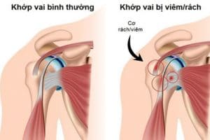 VIÊM KHỚP CĂN BỆNH NGÀY CÀNG PHỔ BIẾN Ở GIỚI TRẺ 4 viêm khớp vai