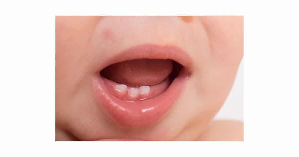 Bệnh trẻ bị còi xương 5 cham moc rang