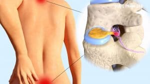 Thoái hóa cột sống