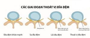 các giai đoạn thoát vị đĩa đệm